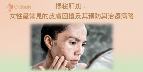 揭秘肝斑:女性最常見的皮膚困擾及其預防與治療策略